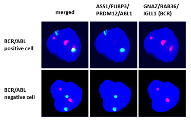 Translokácia génov BCR a ABL pozorovaná fluorescenčnou in-situ hybridizáciou.